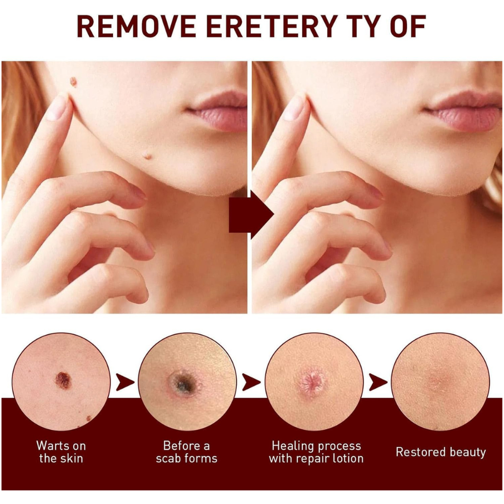 Buy 1 Get 1 Free OFFER🔥Liquid Wart and Skin Tag Removal