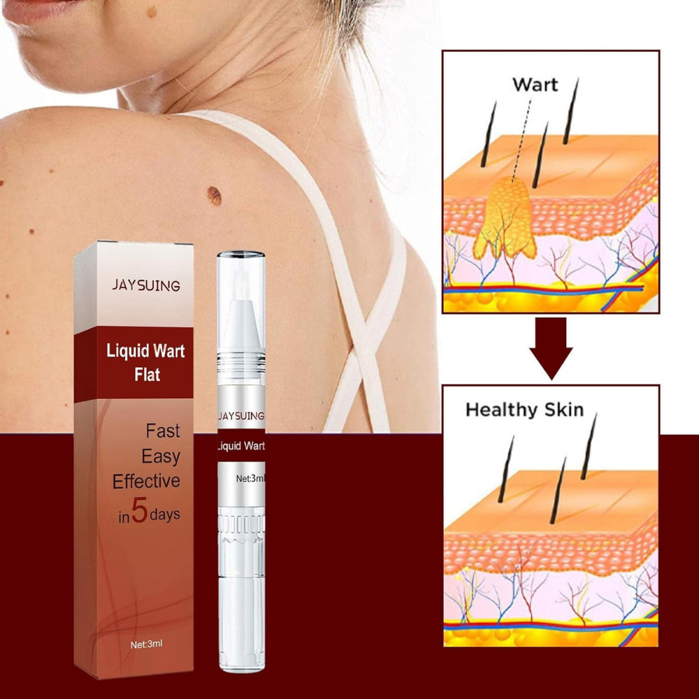 Buy 1 Get 1 Free OFFER🔥Liquid Wart and Skin Tag Removal